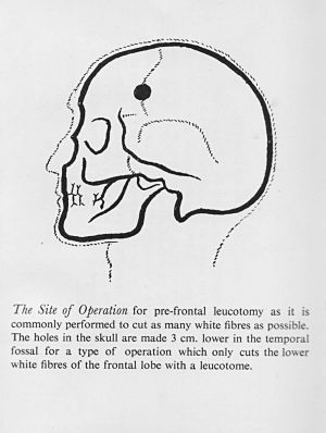 Luecotomy Diagram.